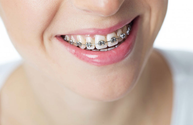 Metal Braces – Orthodontia AE